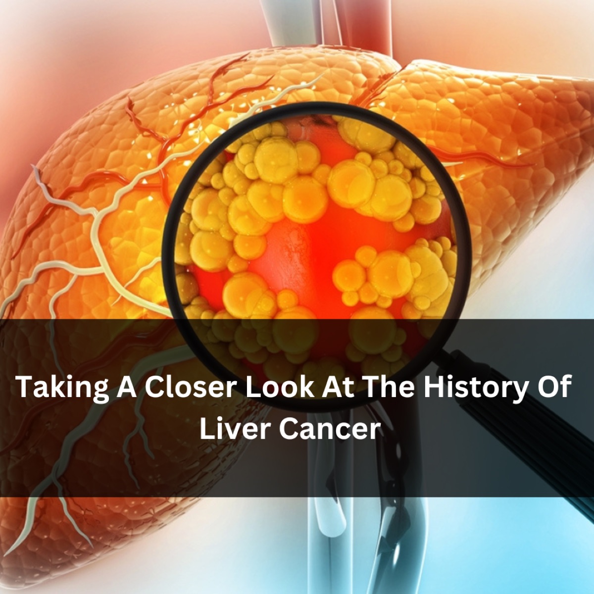 Taking A Closer Look At The History Of Liver Cancer