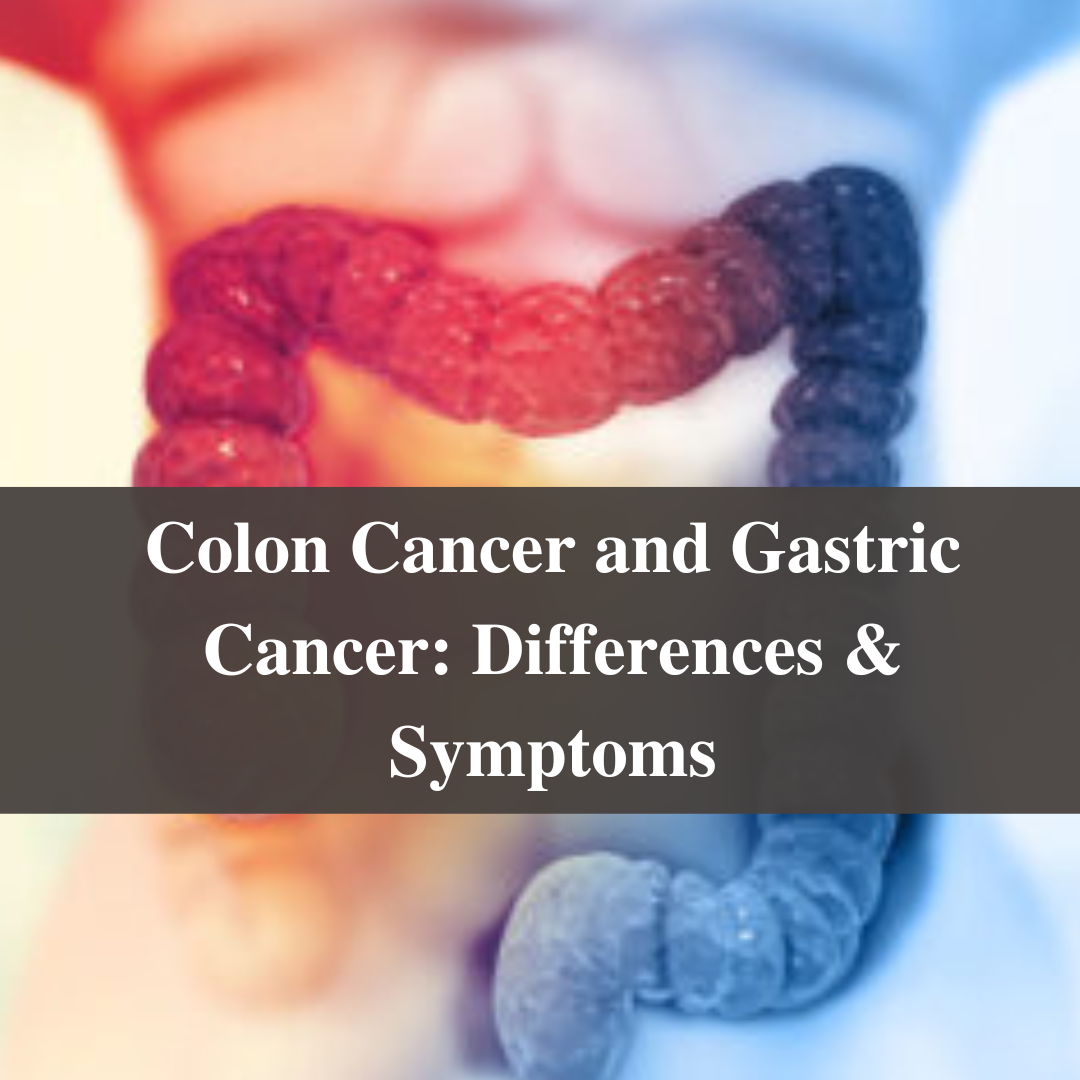Colon Cancer and Gastric Cancer: Differences & Symptoms