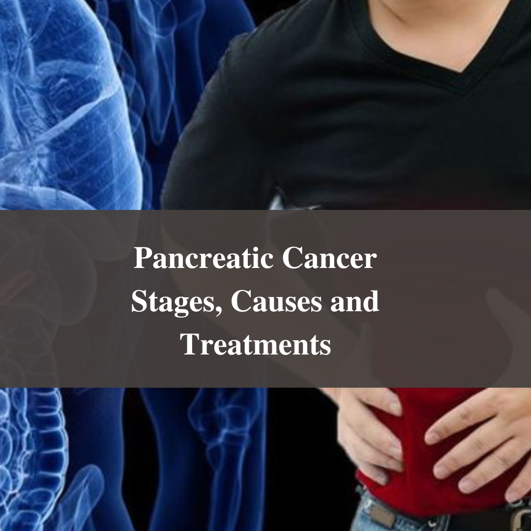 Pancreatic Cancer Stages, Causes and Treatments