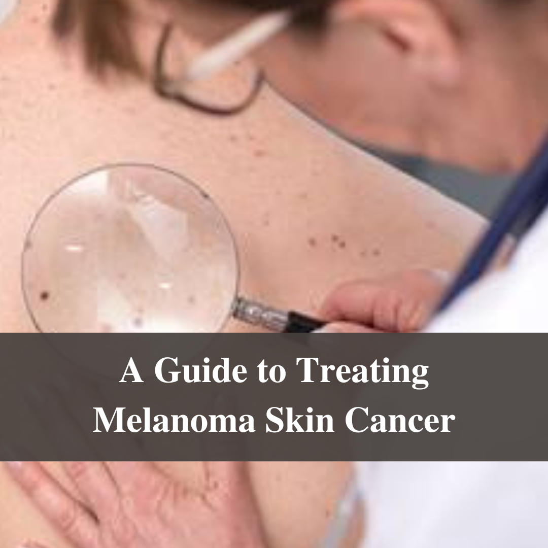 A Guide to Treating Melanoma Skin Cancer