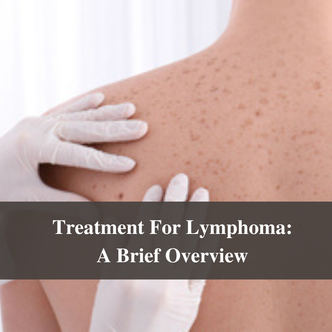 Treatment For Lymphoma: A Brief Overview