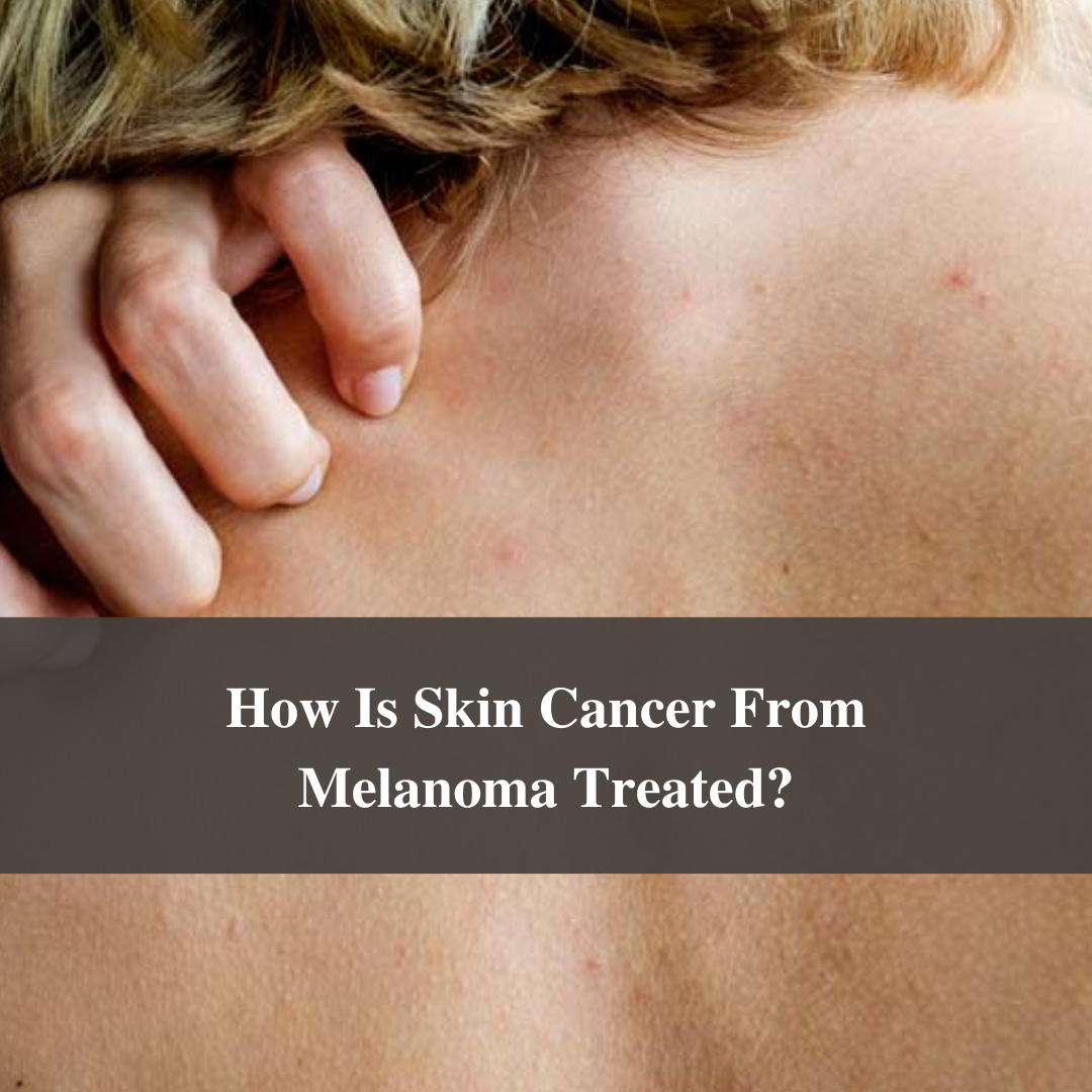 How Is Skin Cancer From Melanoma Treated?