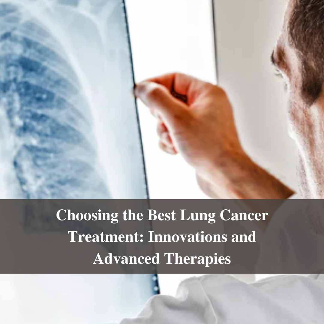 Choosing the Best Lung Cancer Treatment: Innovations and Advanced Therapies