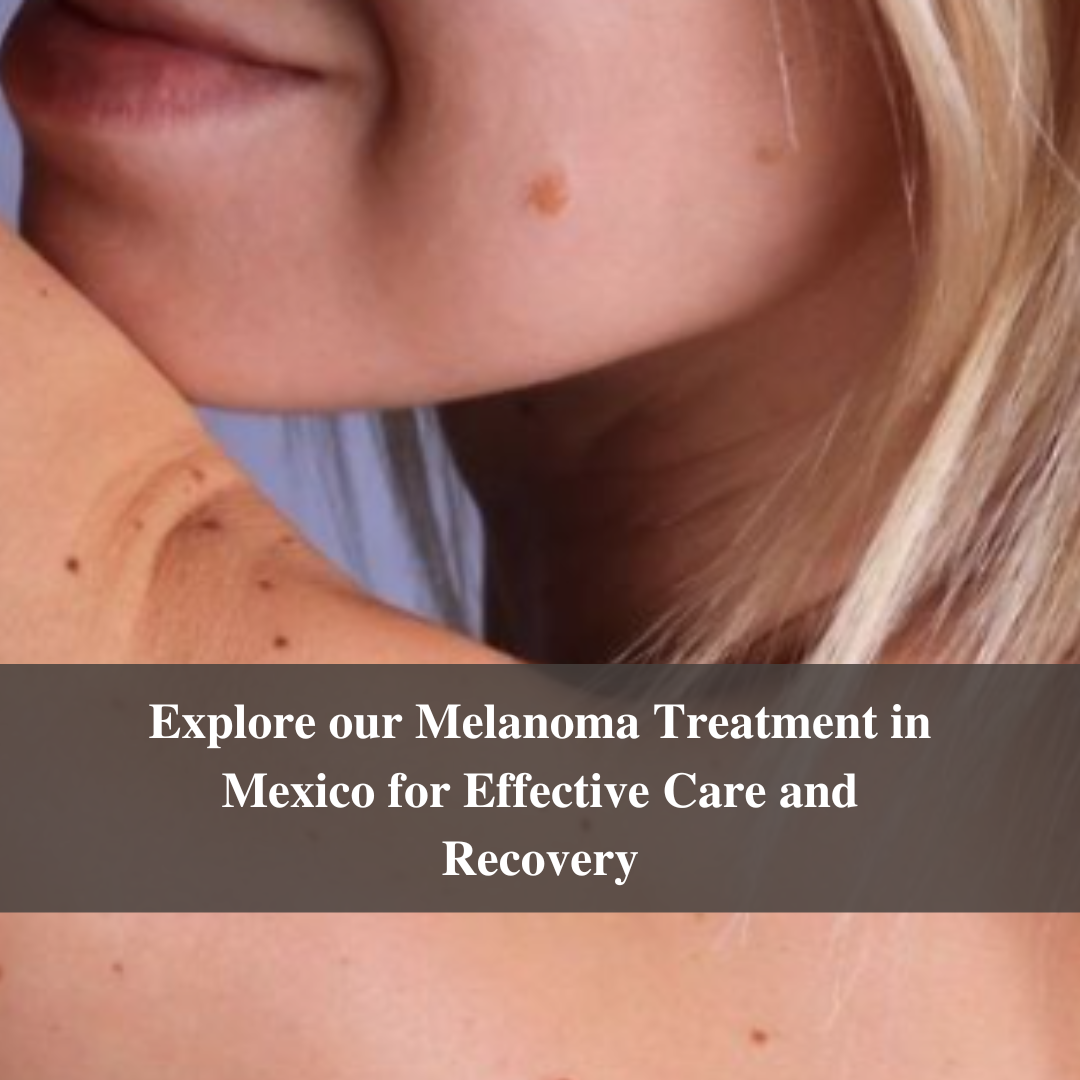 Explore our Melanoma Treatment in Mexico for Effective Care and Recovery