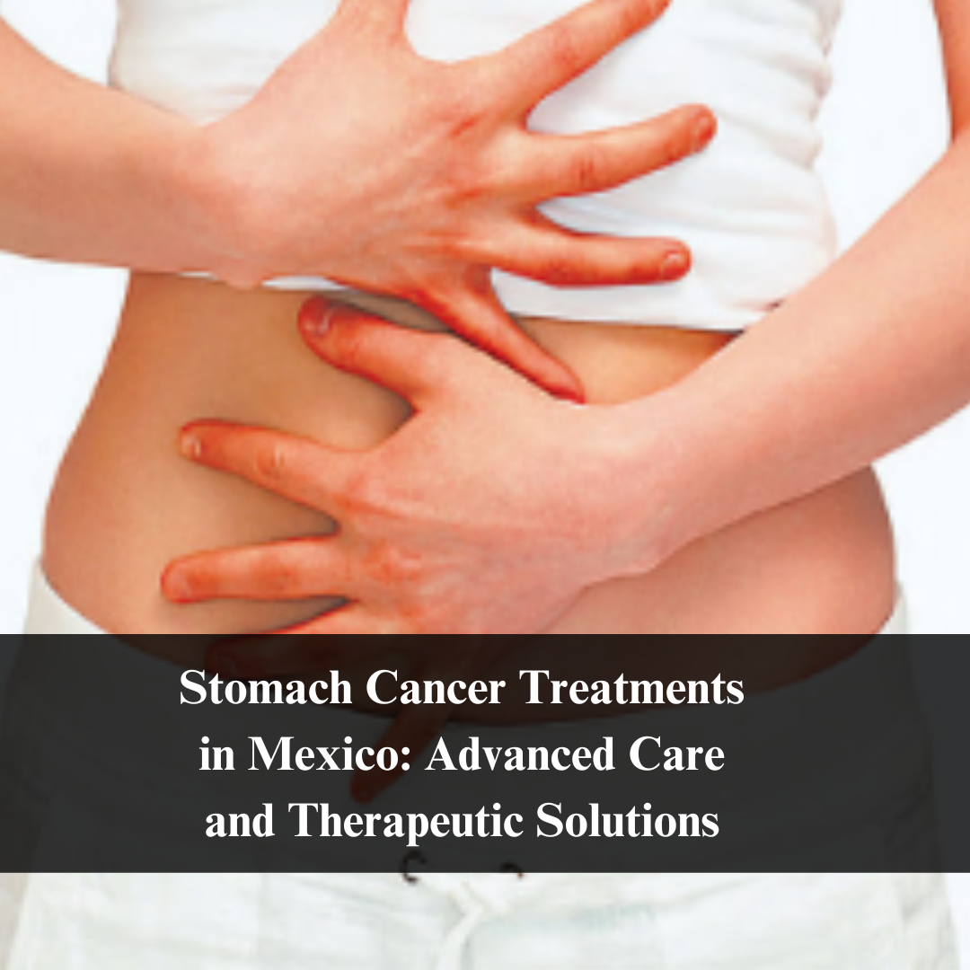 Stomach Cancer Treatments in Mexico: Advanced Care and Therapeutic Solutions